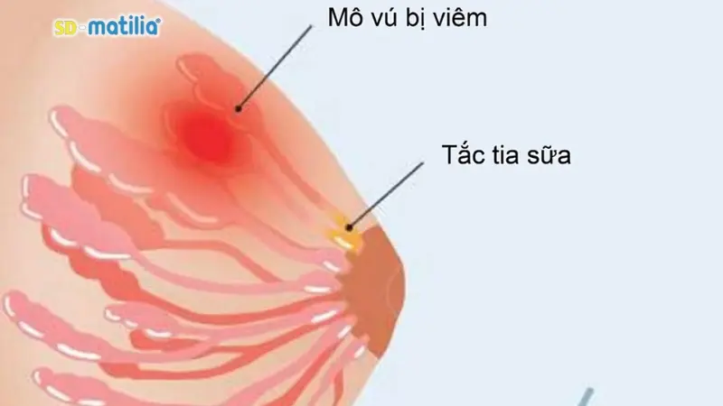 Sưng vú, tắc tuyến sữa sau sinh