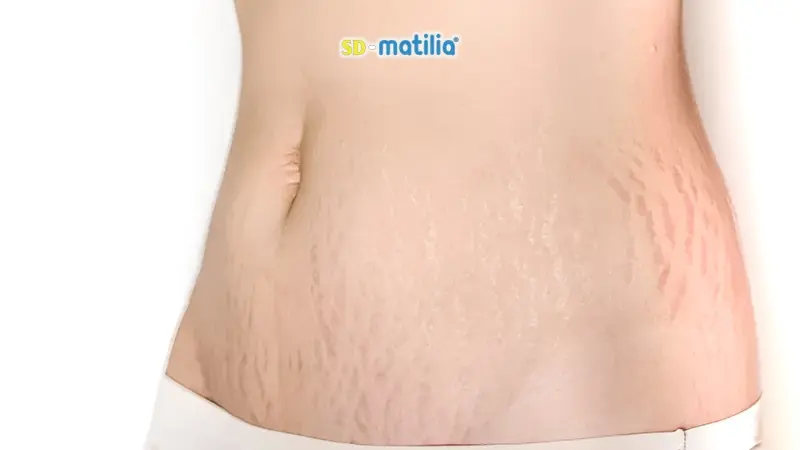 Rạn da sau khi sinh con